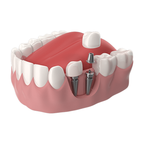 Perdi 1 dente
